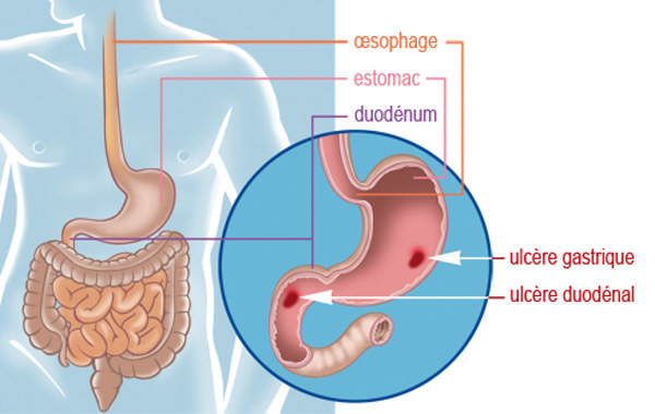 Ulcère de l'estomac gastro-duodénal Tunisie | Dr Sami Boudabbous